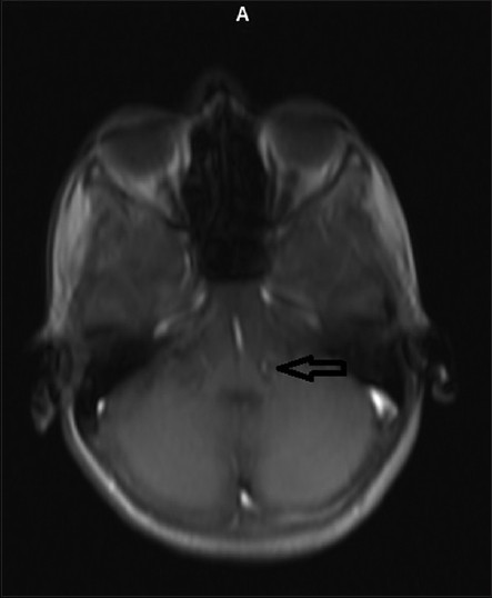 Transverse section in MRI showing solitary ring enhancing lesion in the pre-aqueductal region of mid brain of size 0.72 × 0.68 cm involving IIIrd nerve nucleus with peri lesional edema